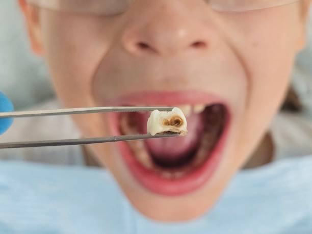 Best Emergency Root Canal Treatment in Cridersville, OH
