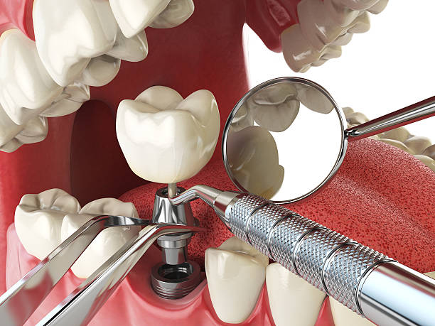 Best Emergency Denture Repair in Cridersville, OH
